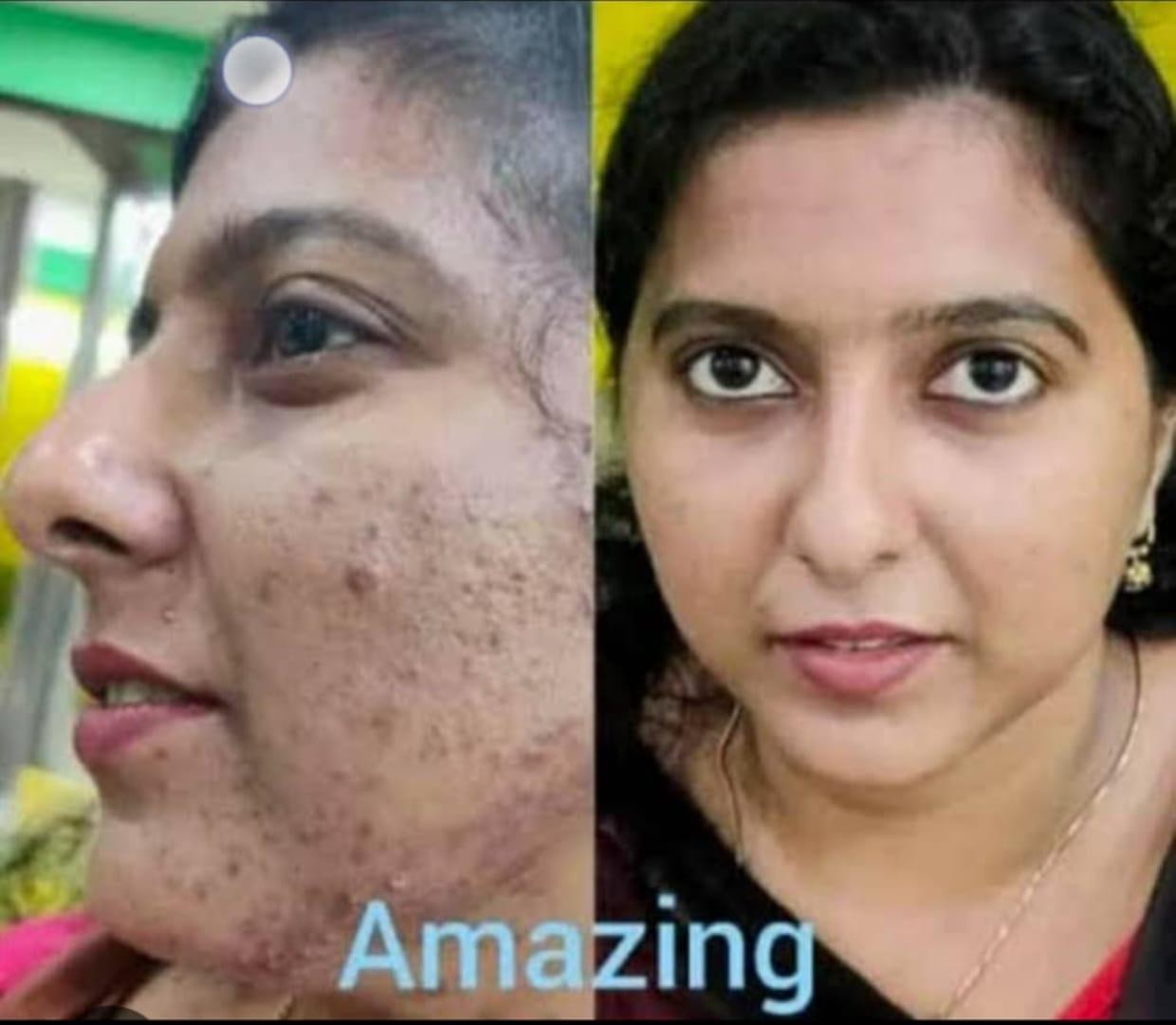 Skin Result