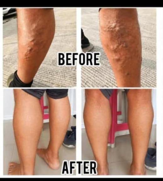 Varicose Veins Result